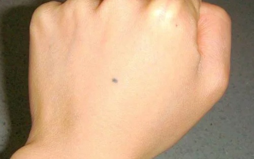 nốt ruồi ở mu bàn tay trái