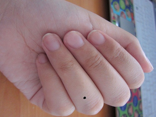 nốt ruồi ở ngón tay đeo nhẫn