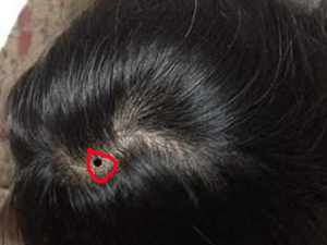 nốt ruồi trên đầu