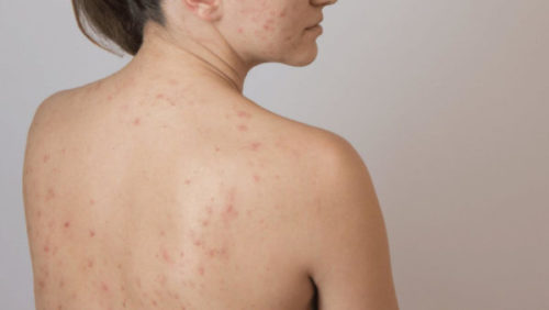 Trị thâm mụn lưng triệt để trong 1 tuần với hiệu quả không thể ngờ tới