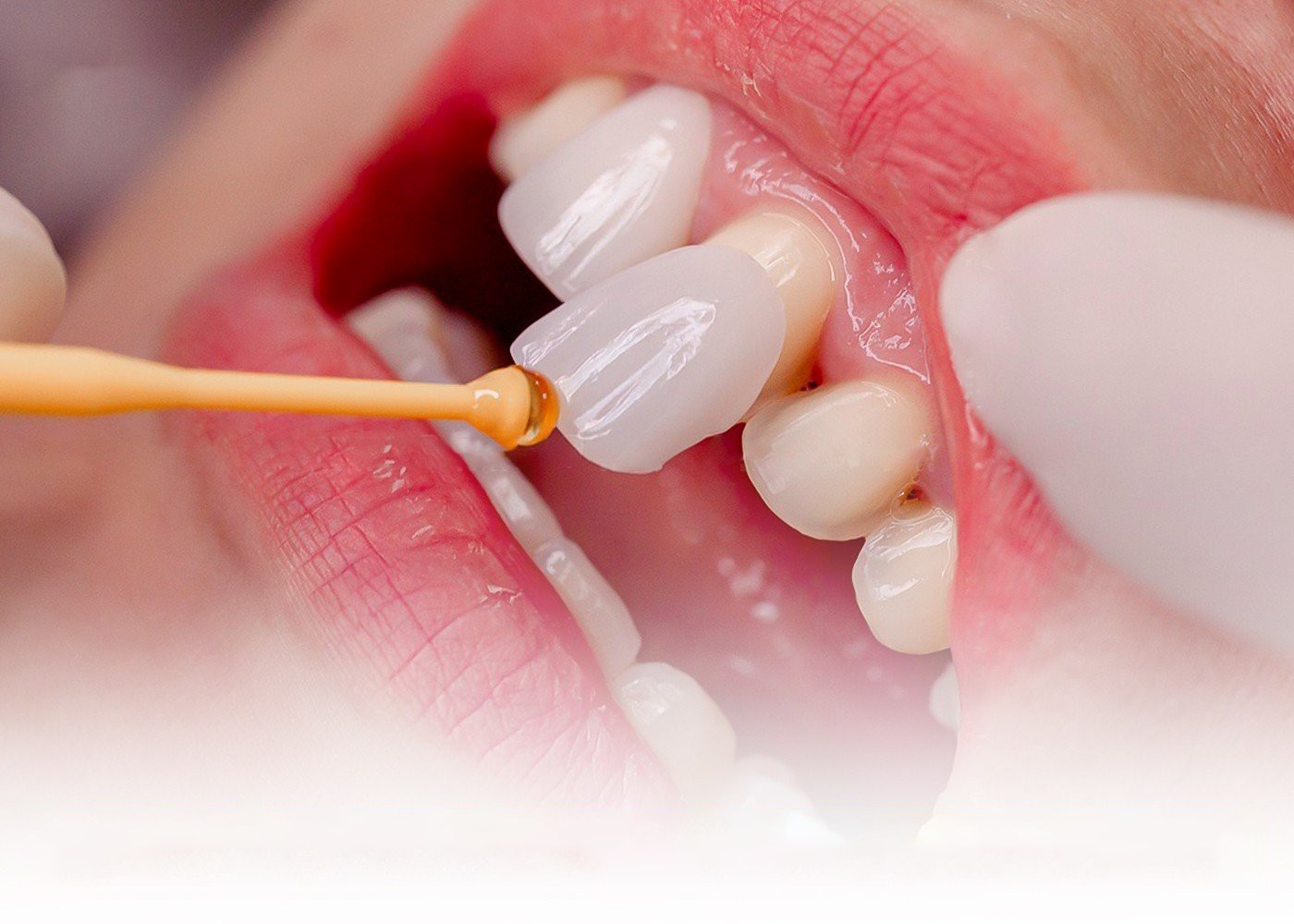 Dịch vụ trám răng an toàn, đạt hiệu quả tốt