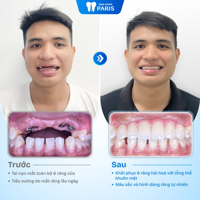 Hình ảnh trước và sau khi trồng răng ở Paris