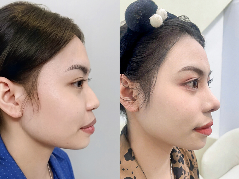 khách hàng nâng mũi tại kangnam hài lòng