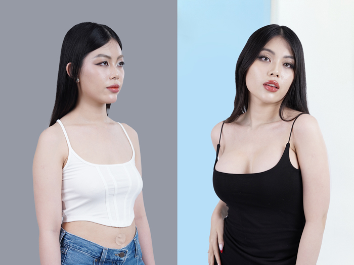 khách hàng hài lòng sau nâng ngực