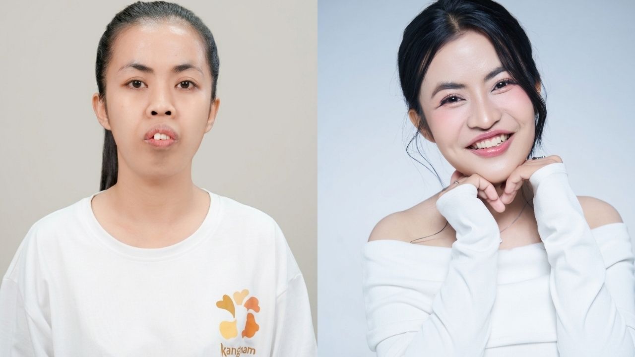 Hình ảnh trước và sau khi phẫu thuật của Trà My