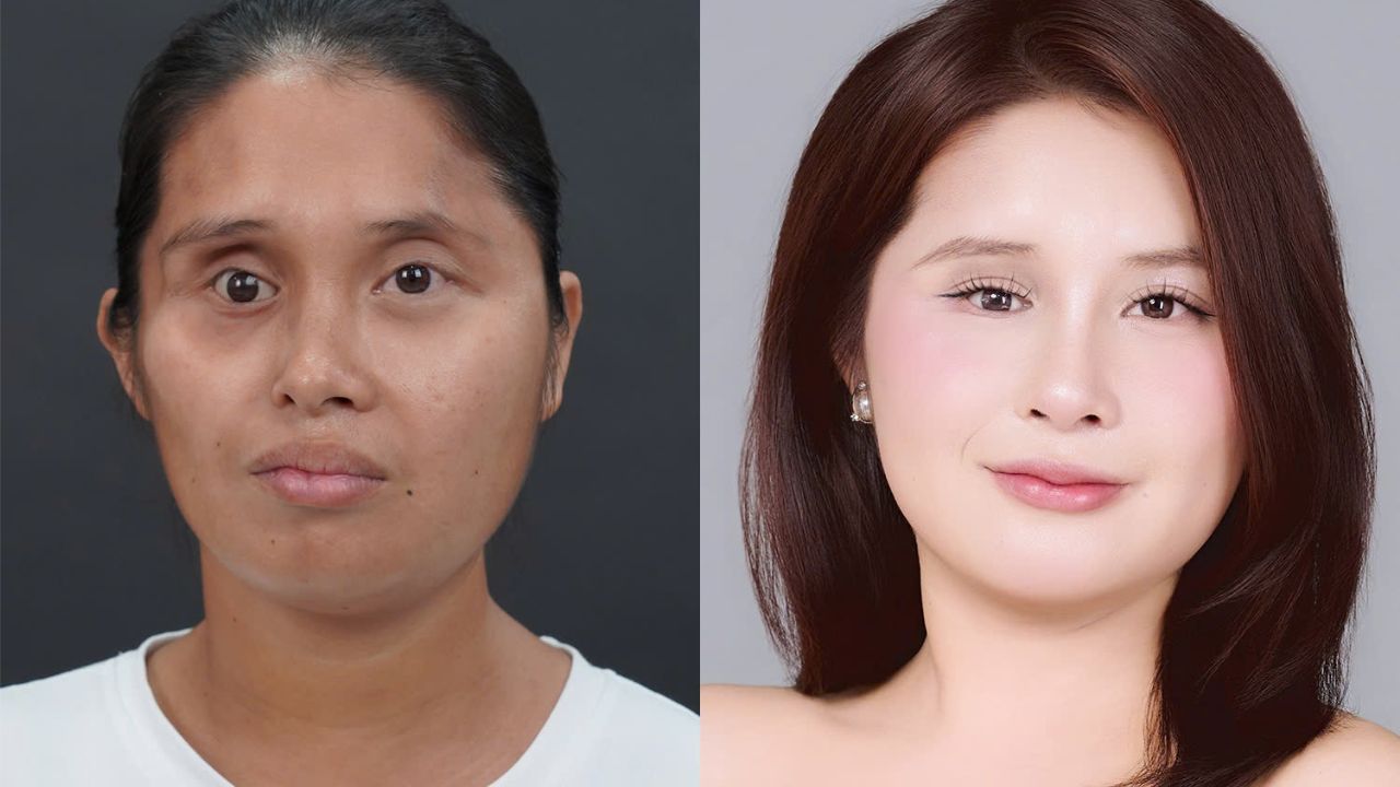 Kangnam có bác sĩ chuyên xử lý ca do NST ziczac không? Giải pháp cấy mỡ mặt cho người bất đối xứng