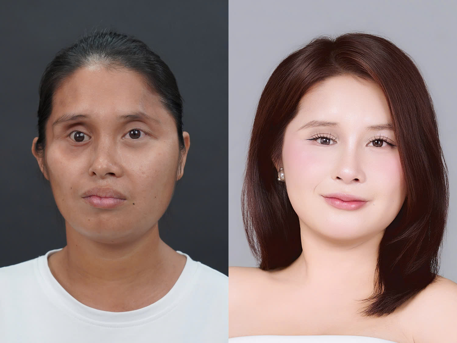 Sau can thiệp, gương mặt Lê Thị Yến đầy đặn, mềm mại và hài hòa hơn.