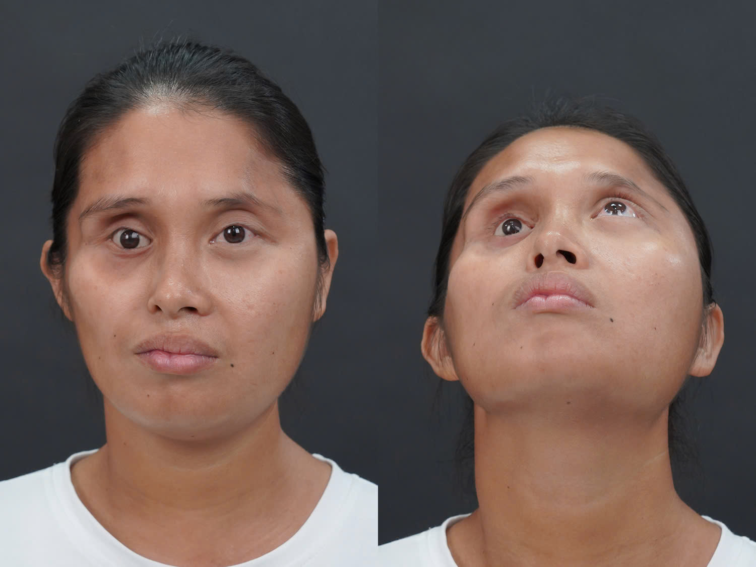 Tình trạng thiếu hụt mô mềm khiến gương mặt Lê Thị Yến mất cân đối rõ rệt trước khi tham gia Hành trình Lột xác mùa 7.